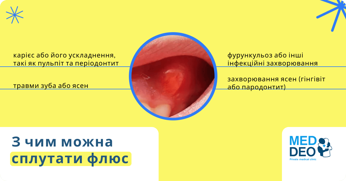 Флюс на яснах: симптоми, причини, види та лікування? 1 з чим можна сплутати флюс