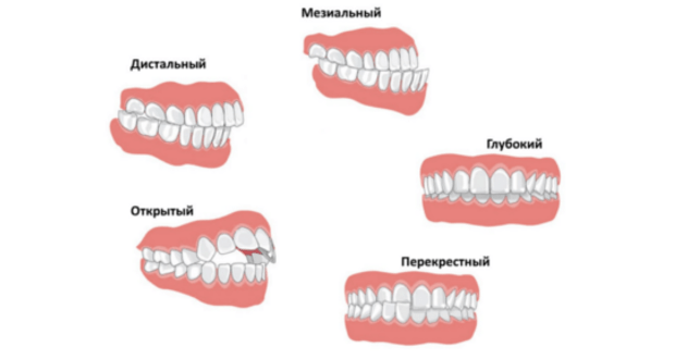 Що таке неправильний прикус та як його виправити?