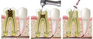 Endodontic Instruments: Types and Classification