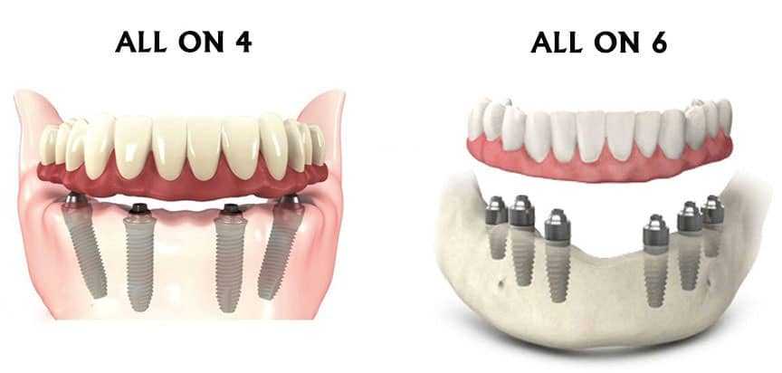 All-on-4 та All-on-6