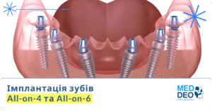 Implantatsiya zubiv–All on 4 ta All on 6_UA
