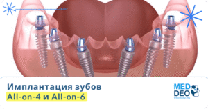 Implantatsiya zubov–All on 4 ta All on 6_RUS