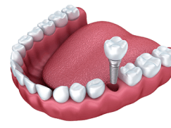 6-implant