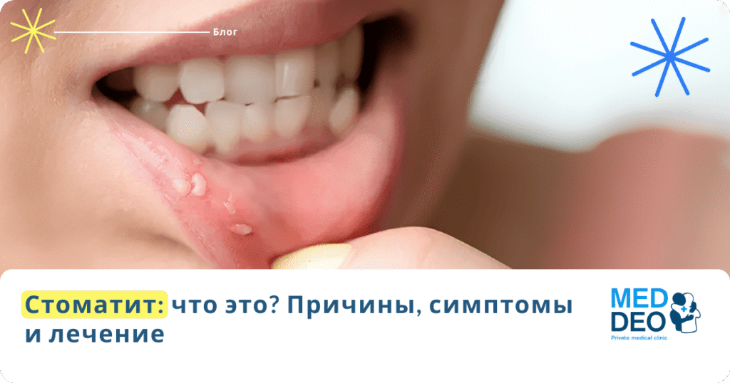 Стоматит: что это? Причины, симптомы и лечение