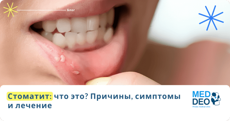 chto takoe stomatit что такое стоматит