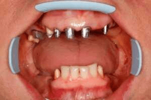 implantacziya zubiv 2