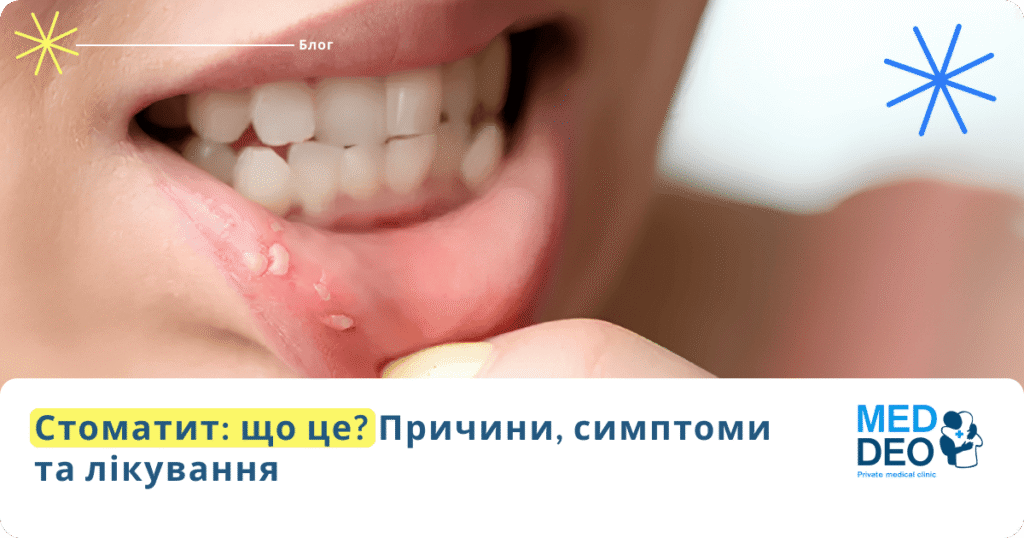 Стоматит: що це? Причини, симптоми та лікування