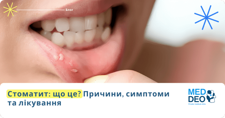що таке стоматит