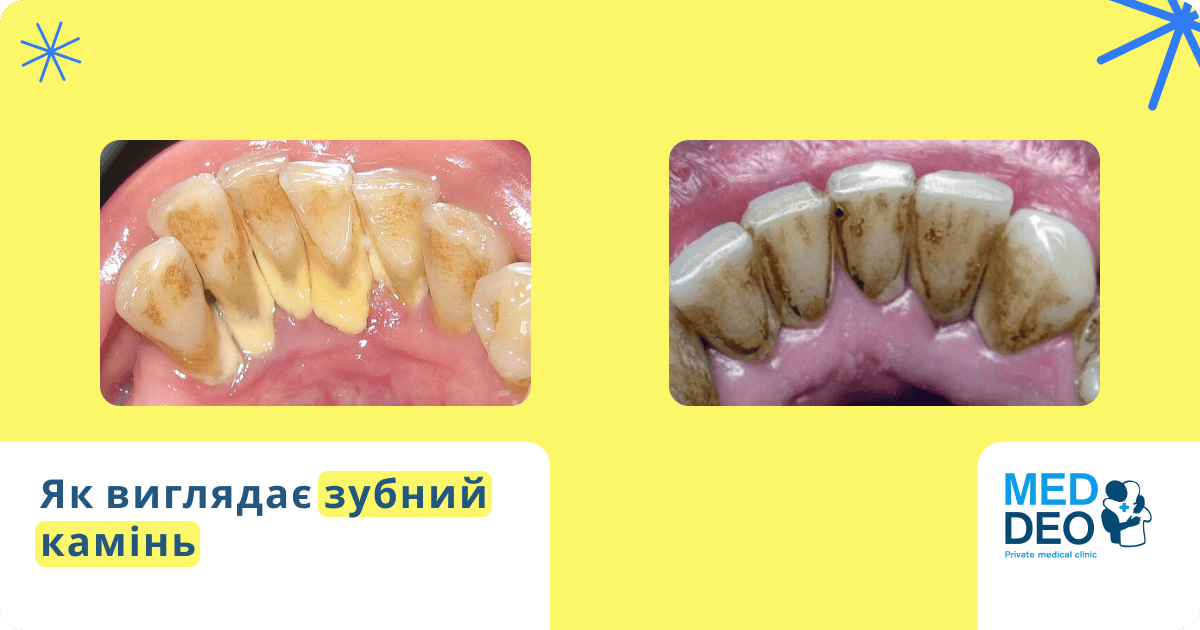 як виглядає зубний камінь