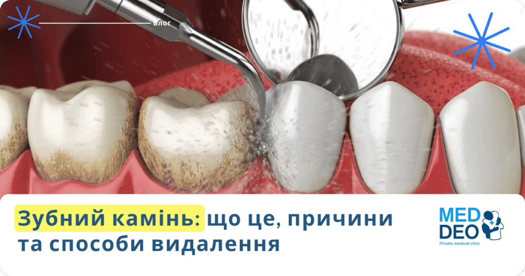 Зубний камінь: що це, причини та способи видалення