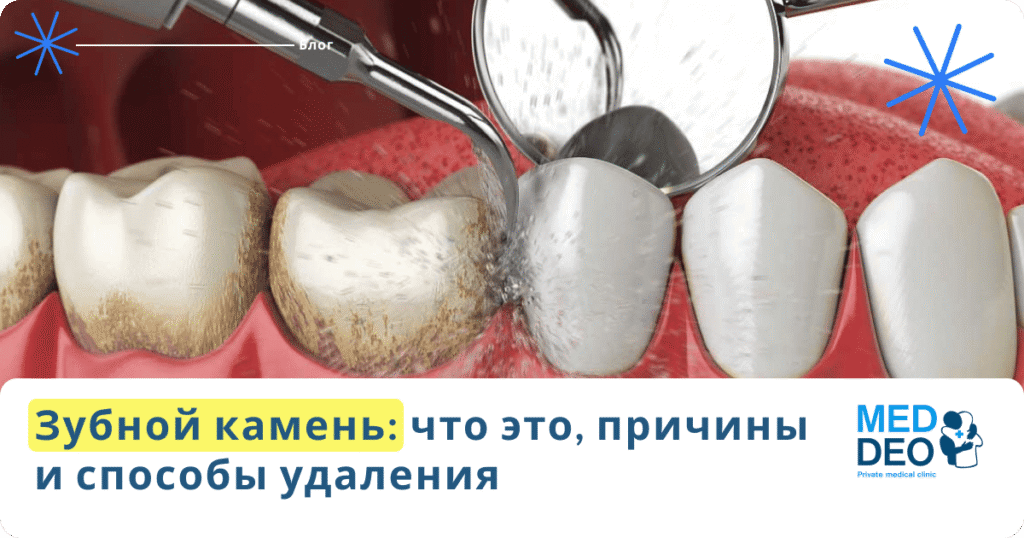 Зубной камень: что это, причины и способы удаления