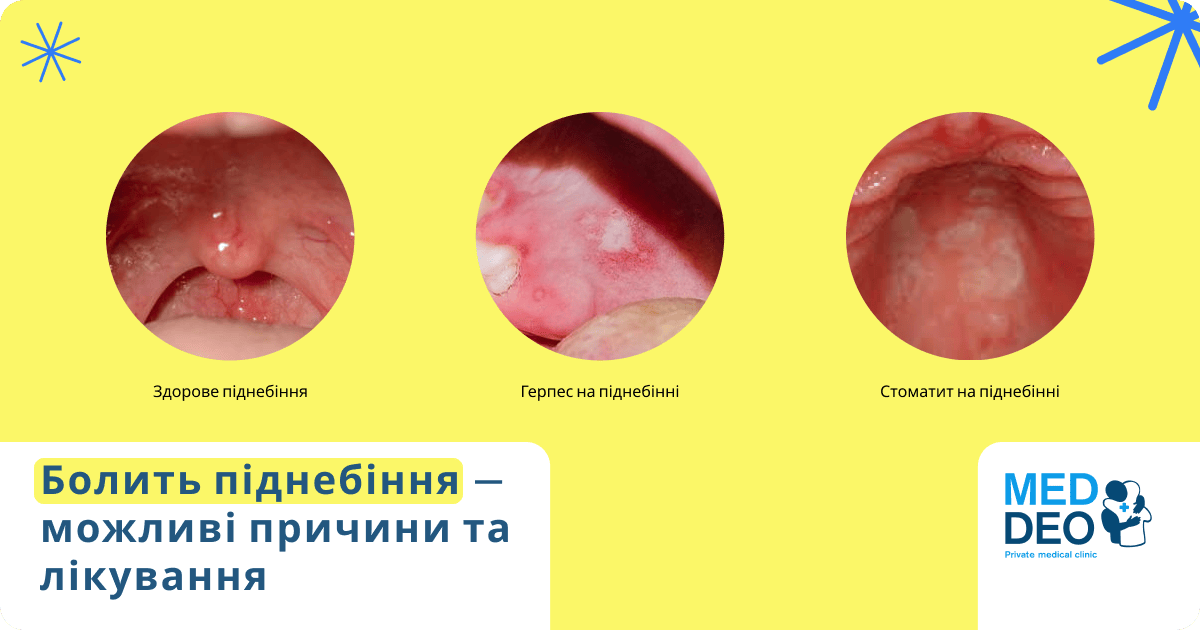 рани на піднебінні - можливі причини