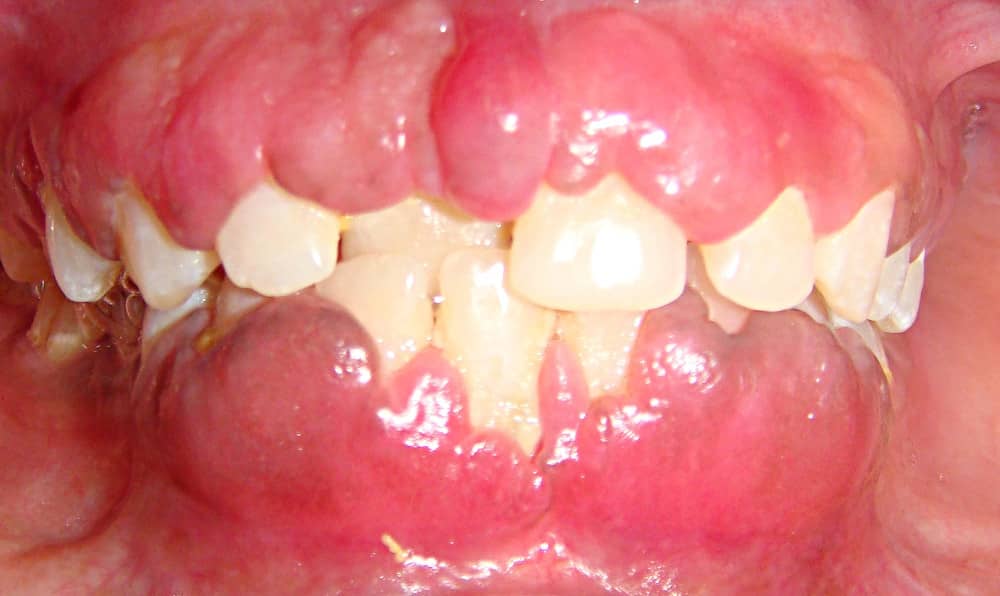 fibromatoz yasen (2)