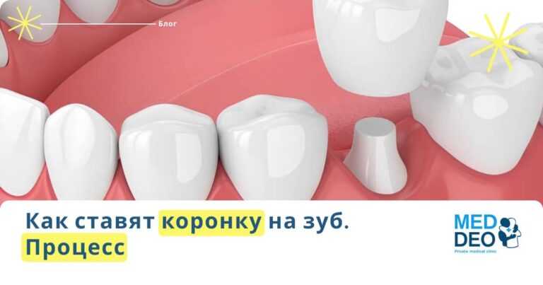 Как ставят коронки на зубы? kak stavyat koronku na zub protsess