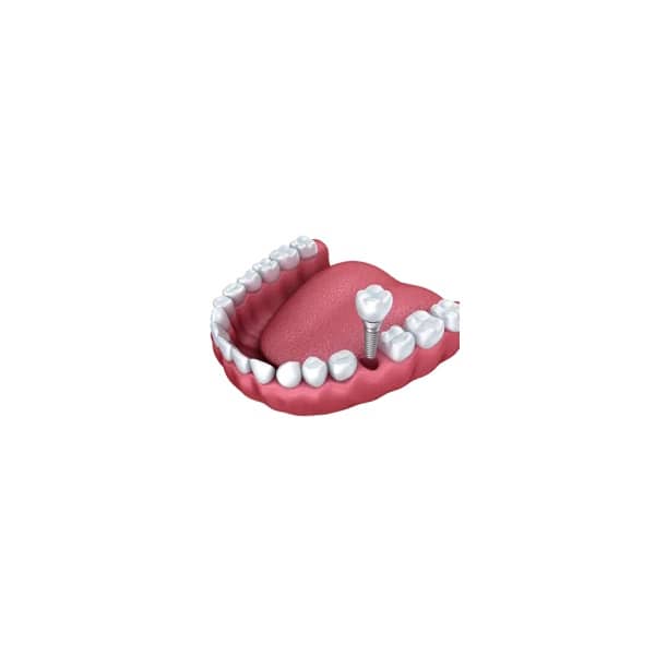 6 implant 600