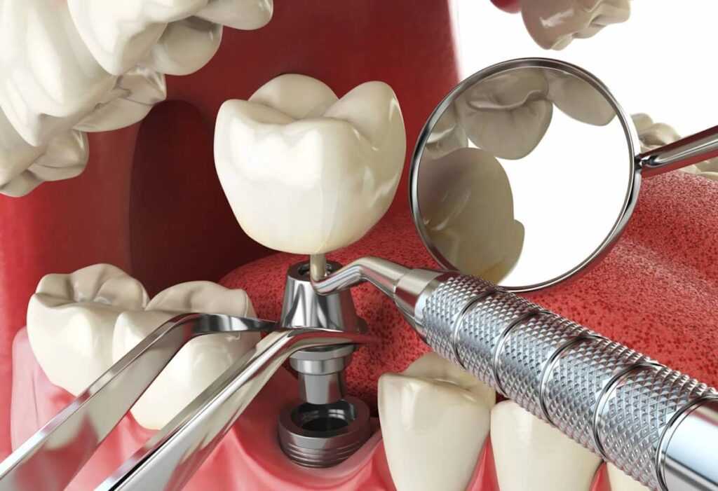 implant zuba імплант зуба