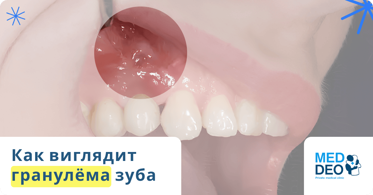 как выглядит гранулема зуба