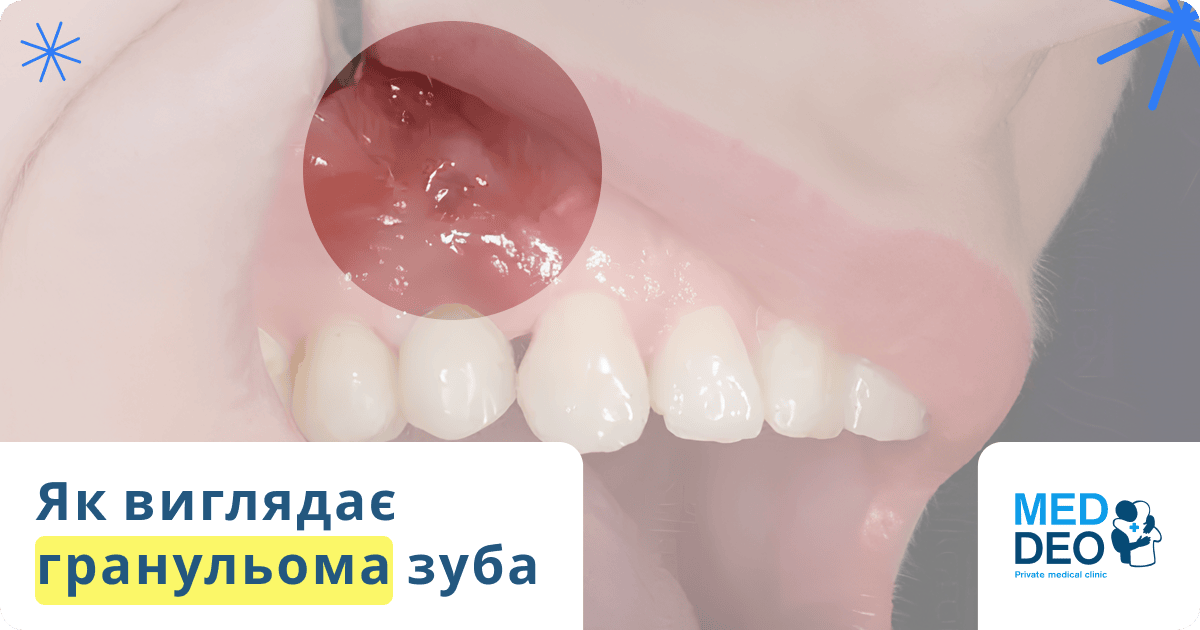 як виглядає гранульома зуба