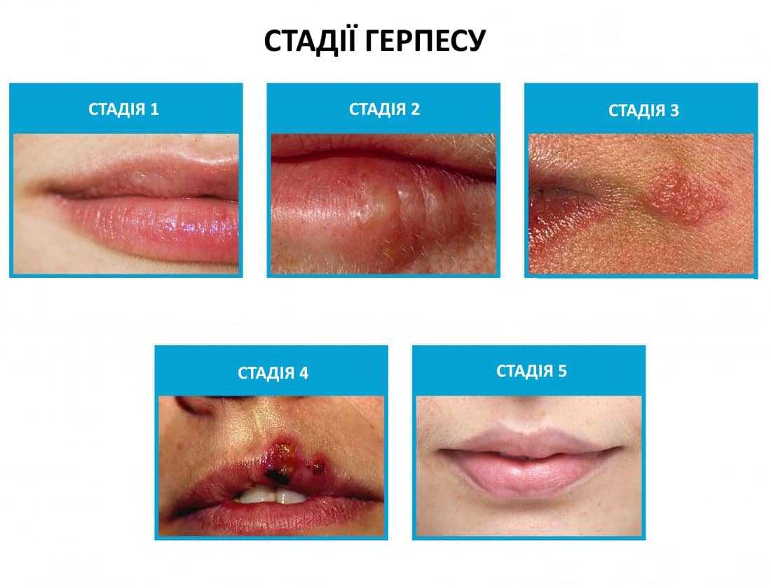 стадії герпесу фото