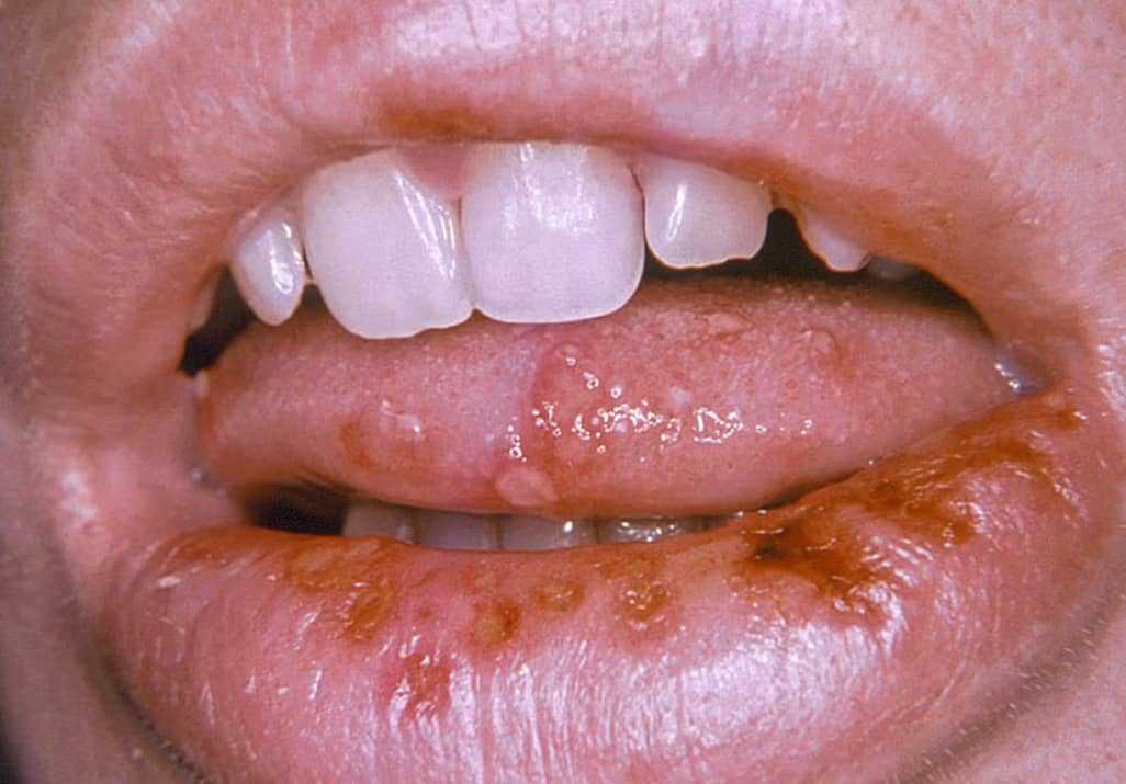 Герпес на язиці, в роті tongue herpes