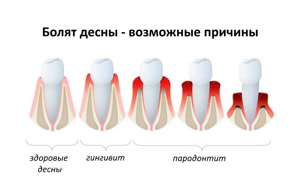 Болят десны: причины, симптомы и эффективные методы лечения bolyat desna 1