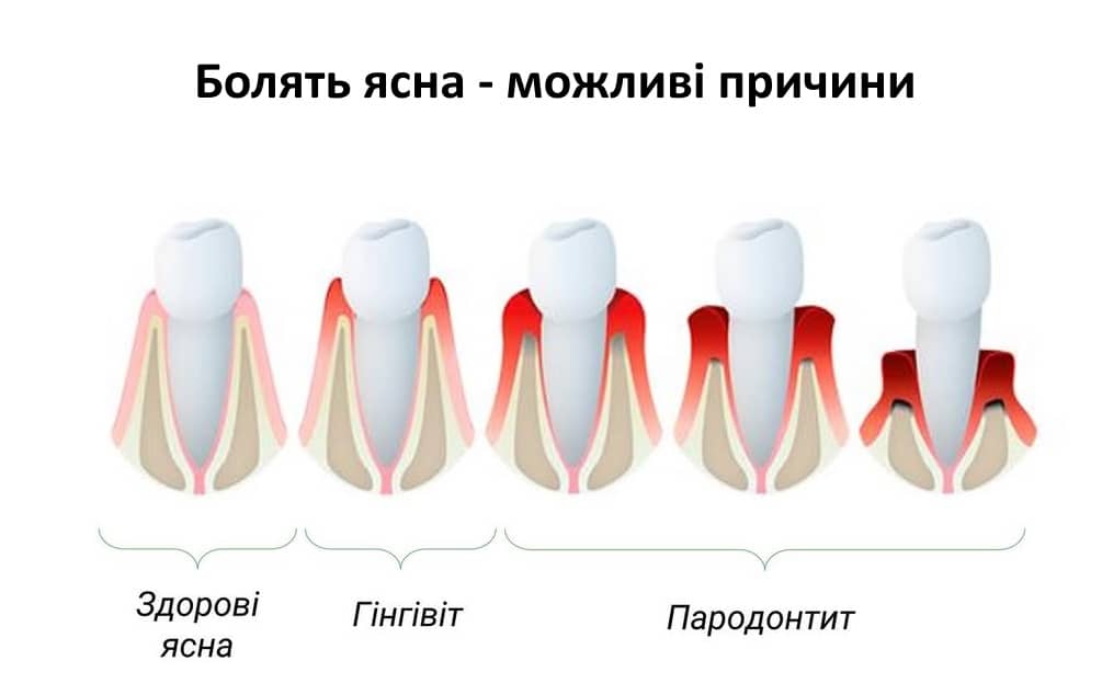 Болять ясна: причини, симптоми та ефективні методи лікування bolyat yasna2 1