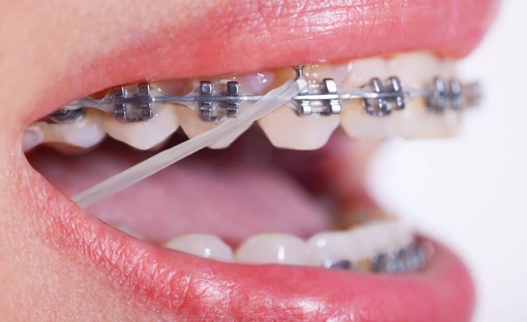 Rubber Bands for Braces – Types, Purpose, and Usage Guidelines
