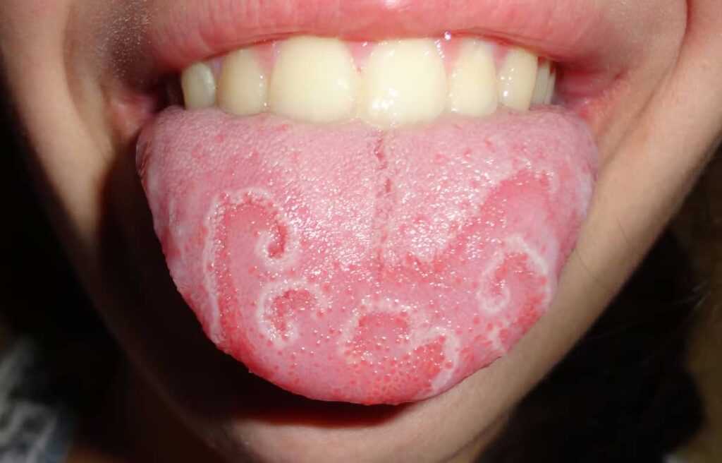 Geographic Tongue: Causes, Symptoms, and How to Treat Red Patches on the Tongue