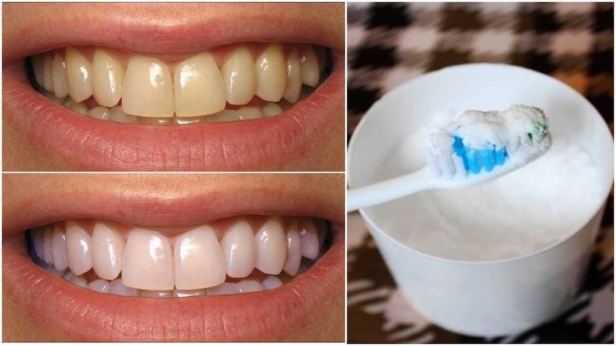 How to Whiten Teeth at Home Without Damaging Them 1 як відбілити зуби содою в домашніх умовах