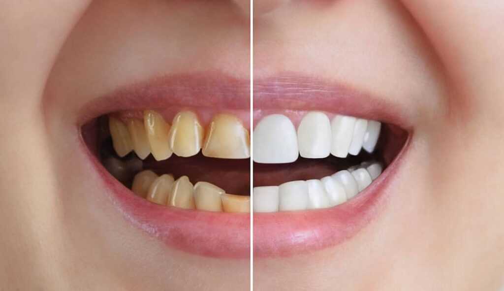 How to Whiten Teeth at Home Without Damaging Them