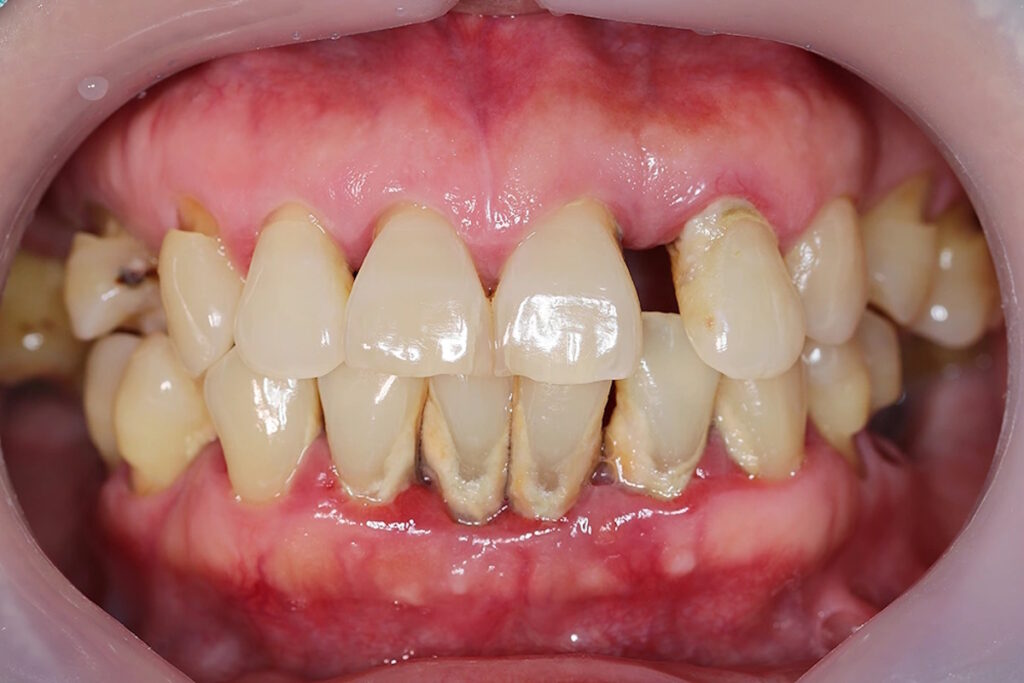 Periodontosis: Understanding the Condition, Symptoms, Causes, and Modern Treatment Approaches