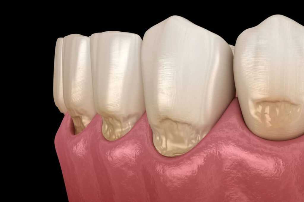 Abfraction (Wedge-Shaped Defects): Causes, Stages, and Modern Treatment Options