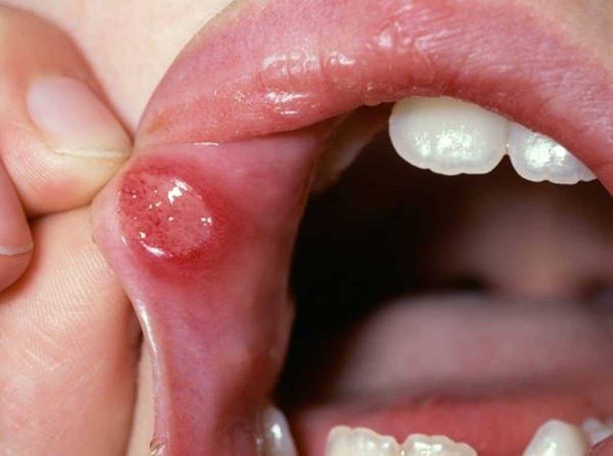 aphthous stomatitis photo