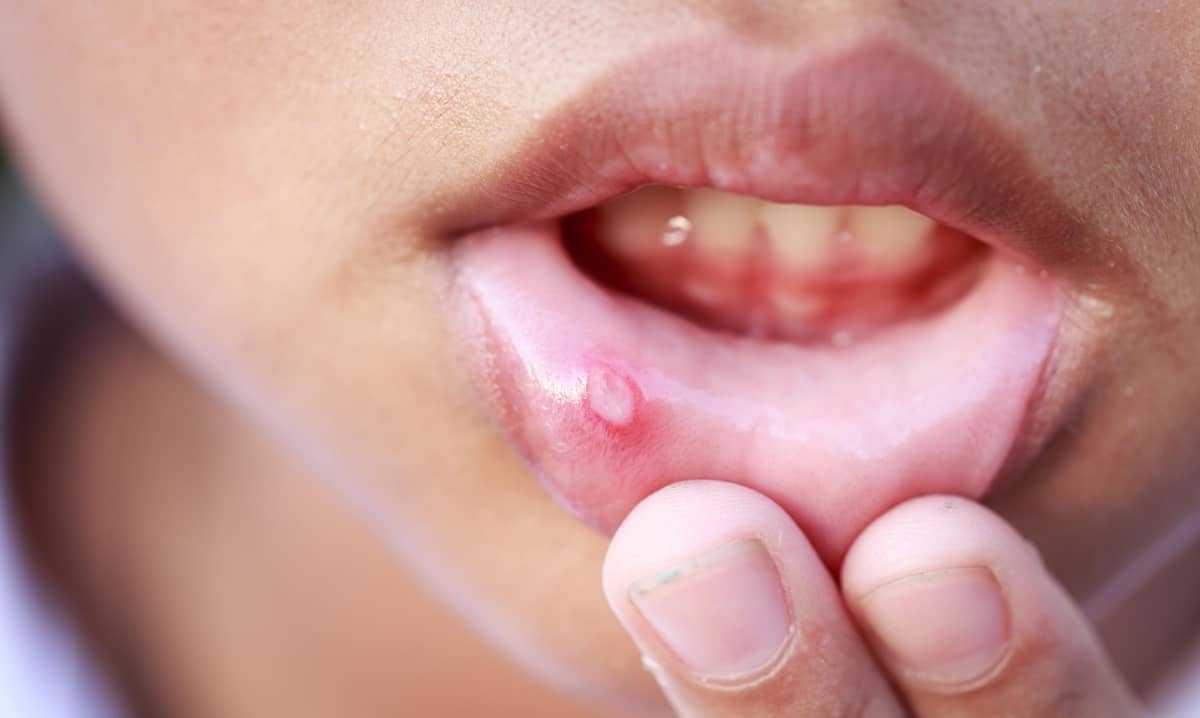 aphthous stomatitis photo