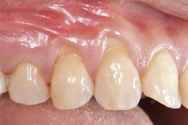 Abfraction (Wedge-Shaped Defects): Causes, Stages, and Modern Treatment Options 3 Клиновидний дефект зубів
