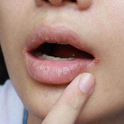 Angular Cheilitis (Mouth Corner Cracks): Causes, Fast Treatment, and Prevention 1 Angular Cheilitis (Mouth Corner Cracks): Causes, Fast Treatment, and Prevention image 2