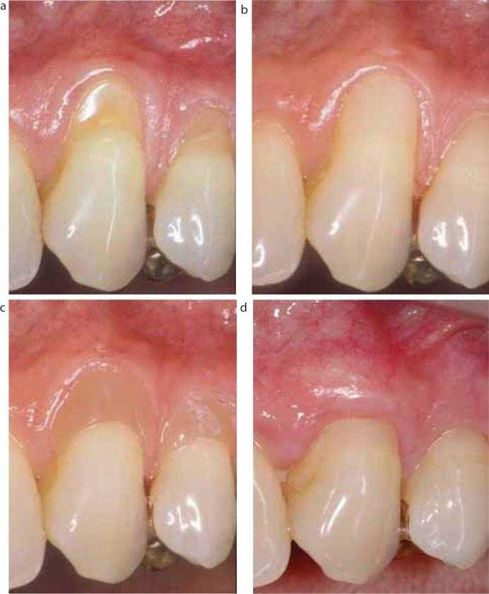 Abfraction (Wedge-Shaped Defects): Causes, Stages, and Modern Treatment Options 2 Клиновидний дефект зубів