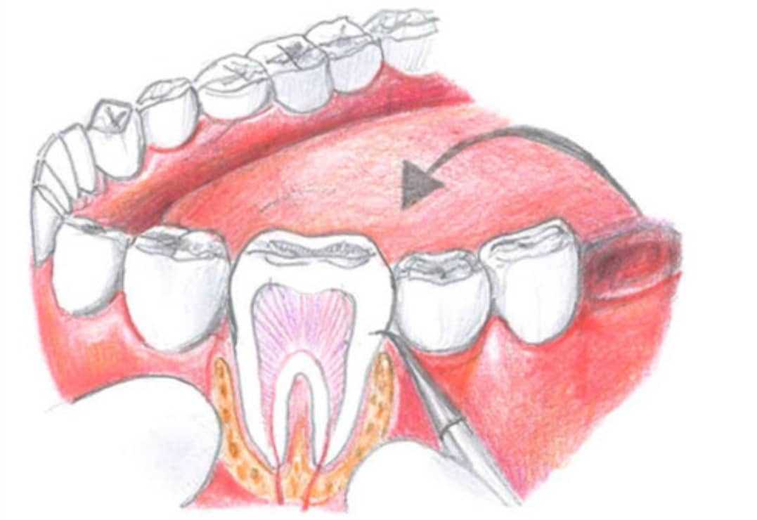 Autotransplantation of Teeth 1 Tooth Autotransplantation