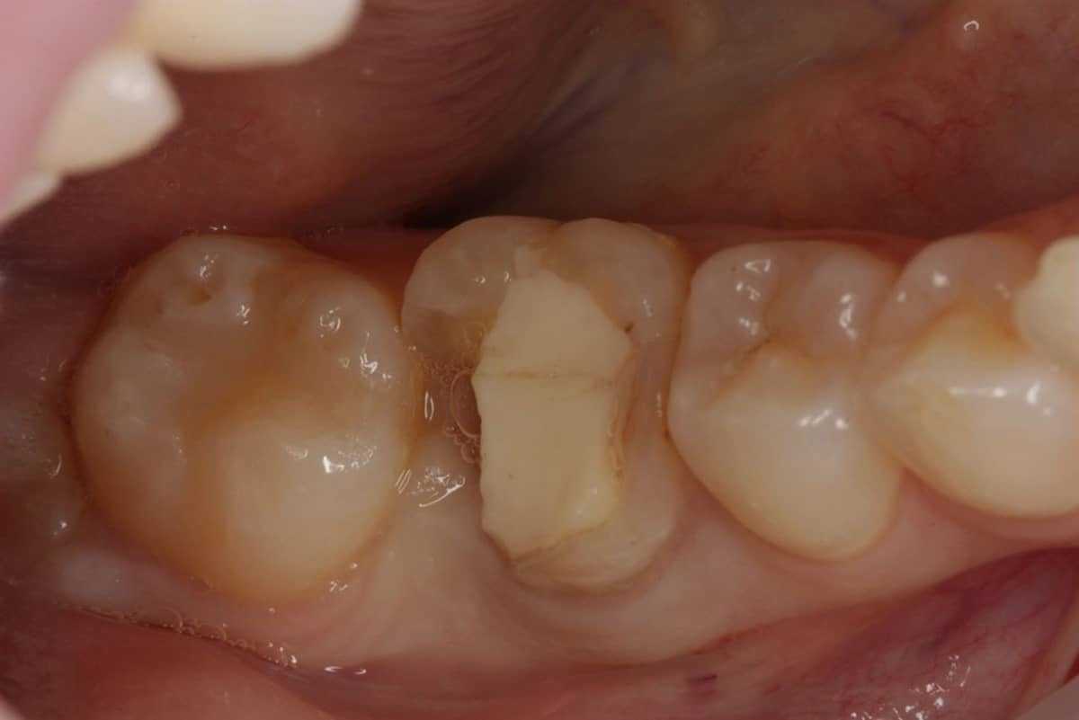 Autotransplantation of Teeth 2 Tooth Autotransplantation