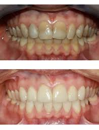 Tooth Polishing: What It Is, How the Procedure Works, and Why You Need It 1 Tooth Polishing: What It Is, How the Procedure Works, and Why You Need It image 1