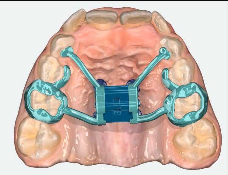 Marco Rossa Appliance for Jaw Expansion
