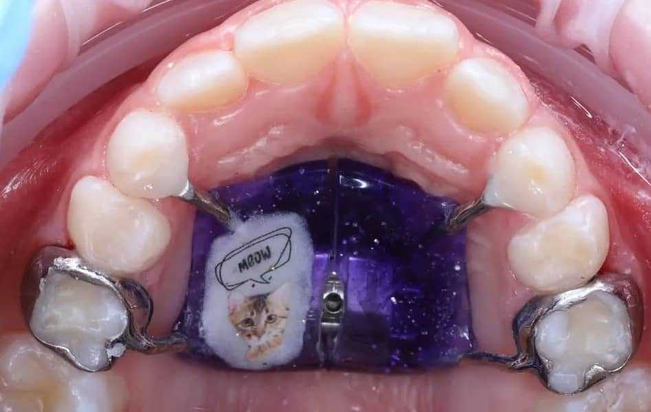 Marco Rossa Appliance for Jaw Expansion 2 аппарат Марко Росса