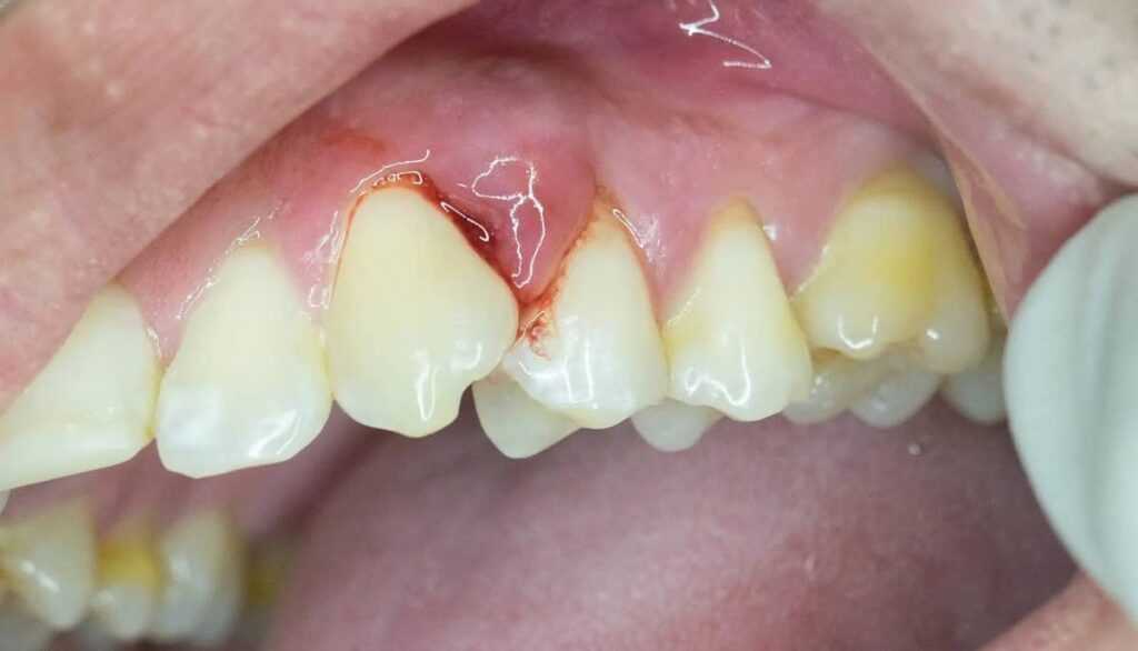 Periodontitis: Symptoms, Stages & Prevention