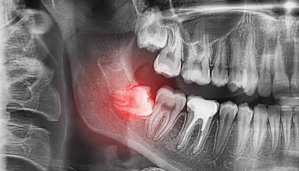 Treatment of Impacted and Ectopic Wisdom Teeth