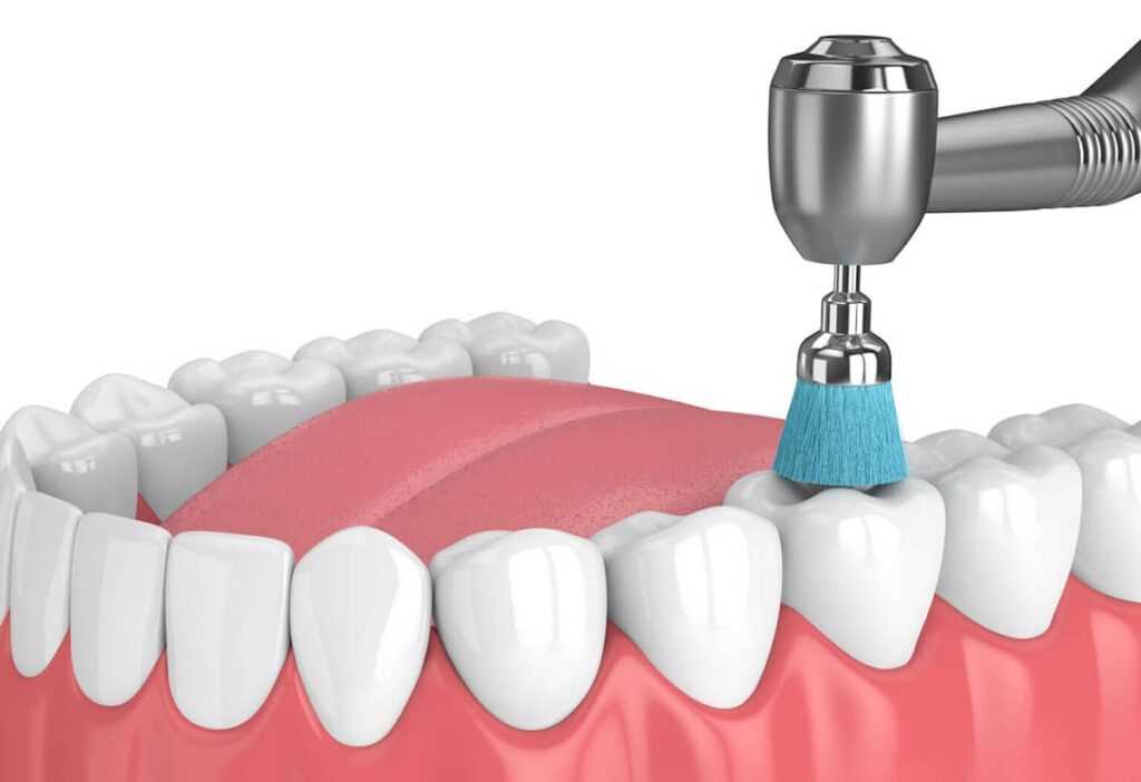teeth polishing Поліровка зубів