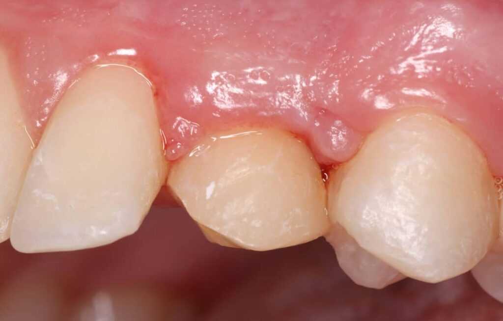 Autotransplantation of Teeth