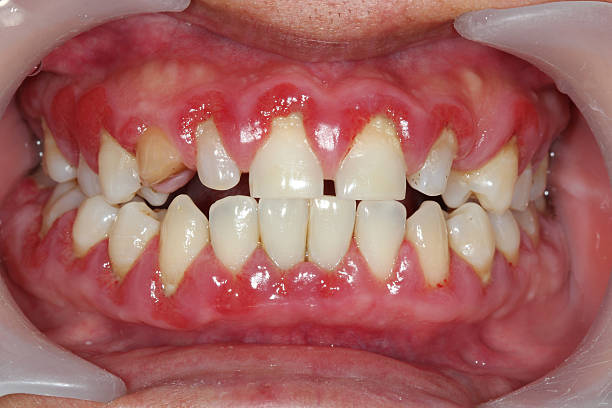 Gingivitis photo