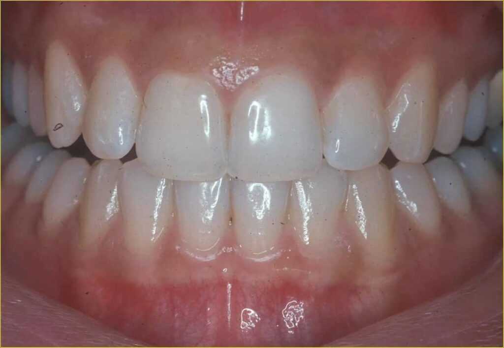 Gingivitis: What It Is, Symptoms, Causes, and How to Prevent Gum Inflammation