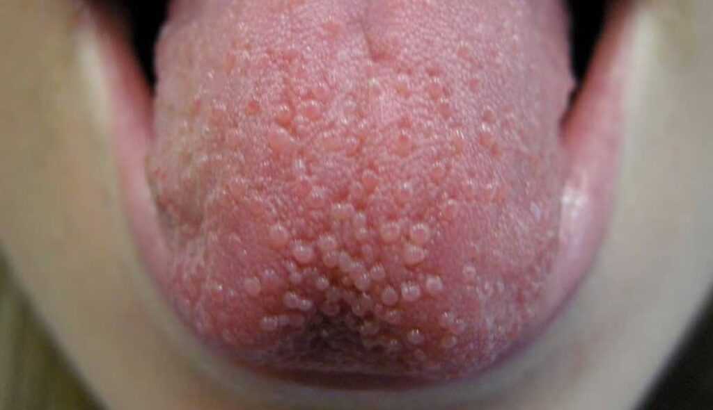 Bumps on the Tongue: Causes, Types, and Effective Treatment