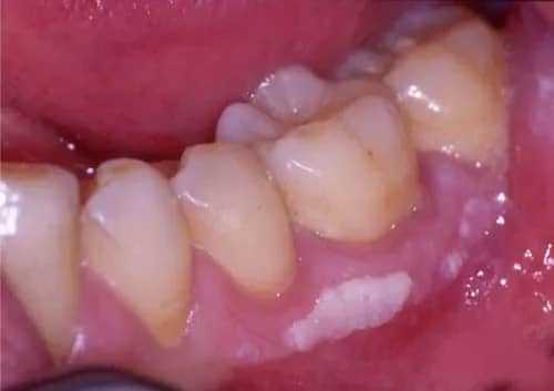 White Plaque on Gums: Causes and Effective Treatment Methods 1 Білий наліт на яснах